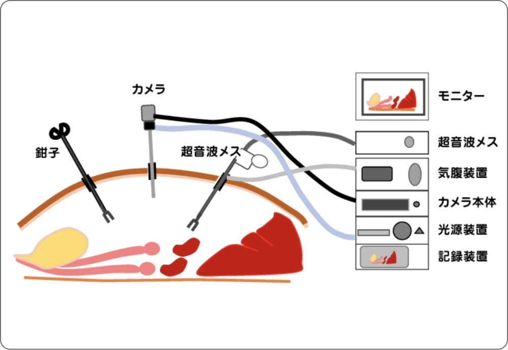 腹腔鏡